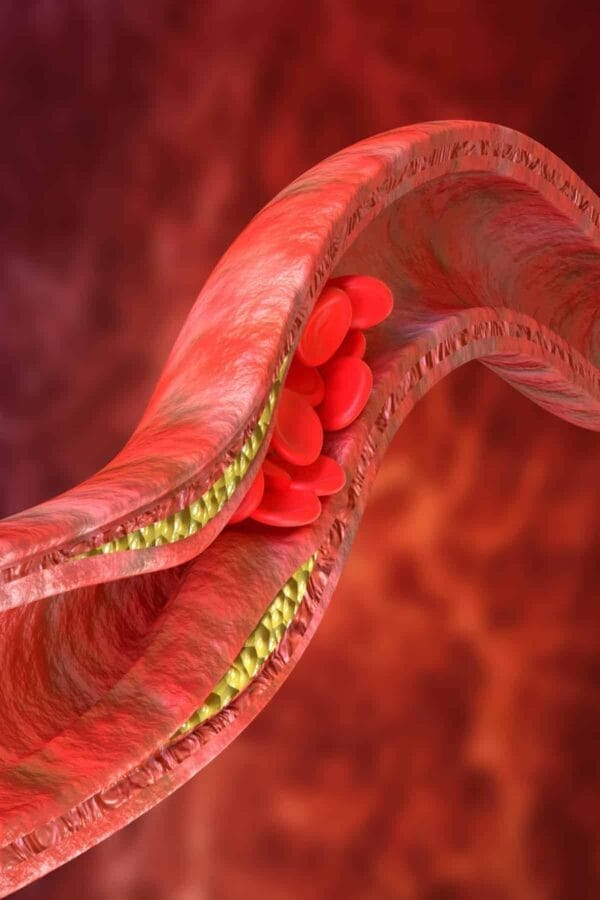 Cholesterol Accumulation