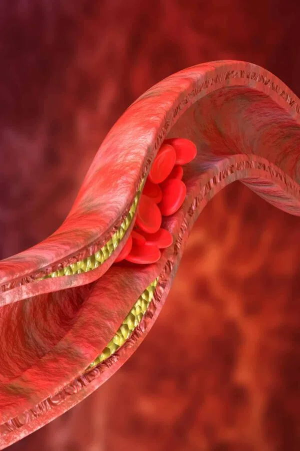 Cholesterol Accumulation
